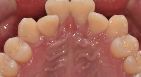 Sangil-dong Orthodontic Dentist: Do Protruding Front Teeth Really Need Orthodontic Treatment? image 3
