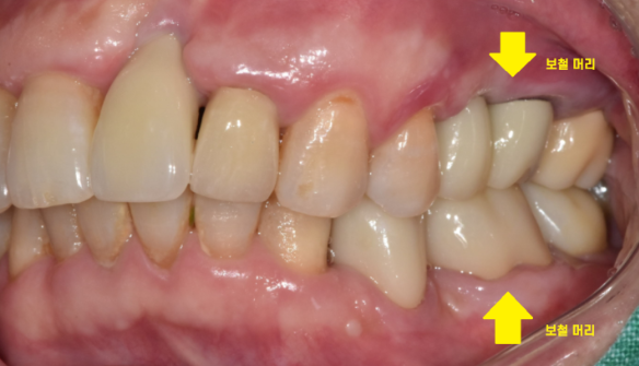 상일동역 치과에서 알려드리는 임플란트 수술과정 대공개 관련 이미지 5