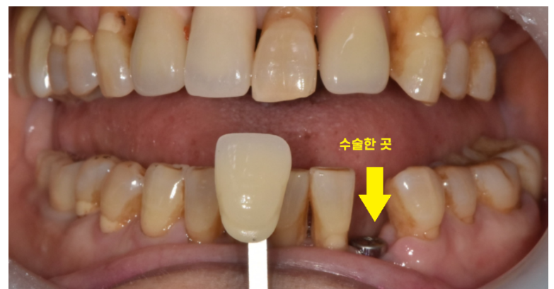 하루만에 임플란트 당일치기가 가능한 조건은?? 관련 이미지 4