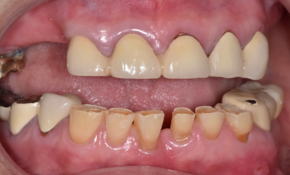 합죽이입 처럼 보이는 이유, 낮아진 관련 이미지 1