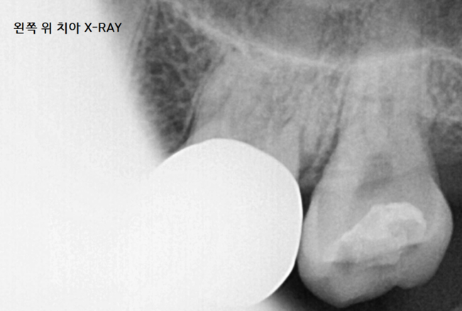 미사역 치과 어금니 뿌리 쪼개짐으로 발치 후 임플란트 했습니다! 관련 이미지 3
