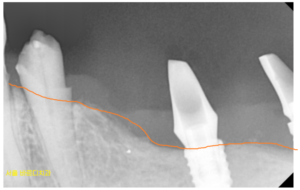 망월동 치과  양쪽 어금니 문제가 있을때 치료 순서는? 관련 이미지 4