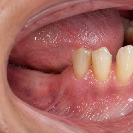 What If Your Front Teeth and Molars Have Problems at the Same Time? The Order of Implant Treatment image 3