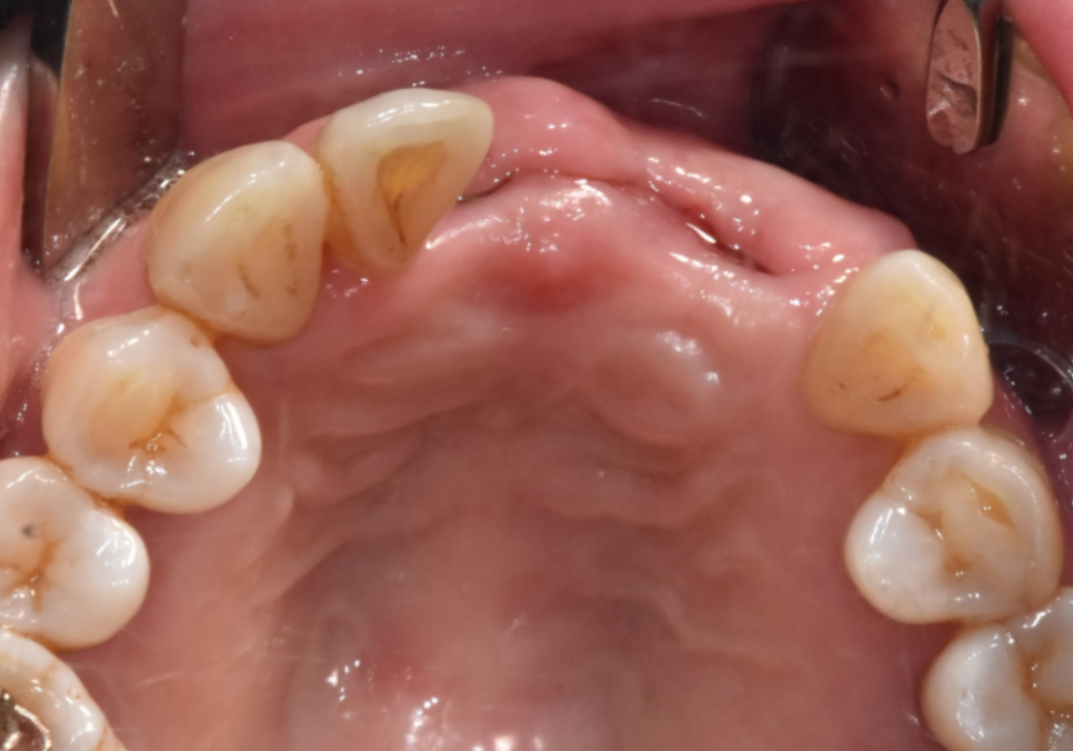 고덕동 임플란트, 튀어나온 앞니, 비용은 줄이고 자연스럽게 개선한 실제 사례 관련 이미지 11