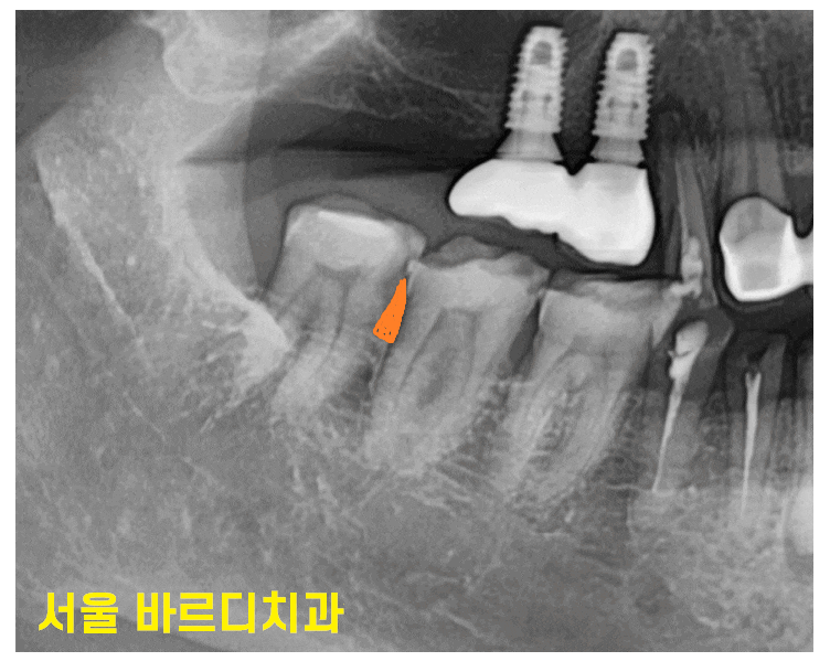 하남 미사 치과 치아 방치하다 올라옴 케이스 보여드립니다. 관련 이미지 1
