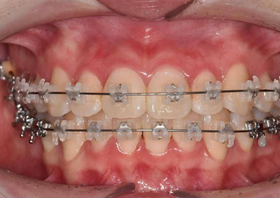 Gangdong-gu Orthodontic Dentistry: I Heard Orthodontic Treatment Causes Tooth Roots to Dissolve? image 4