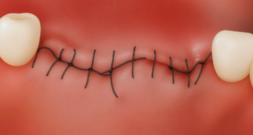 Can I Take a Plane After a Tooth Extraction? Dental Knowledge Patients Should Know Before Traveling image 5