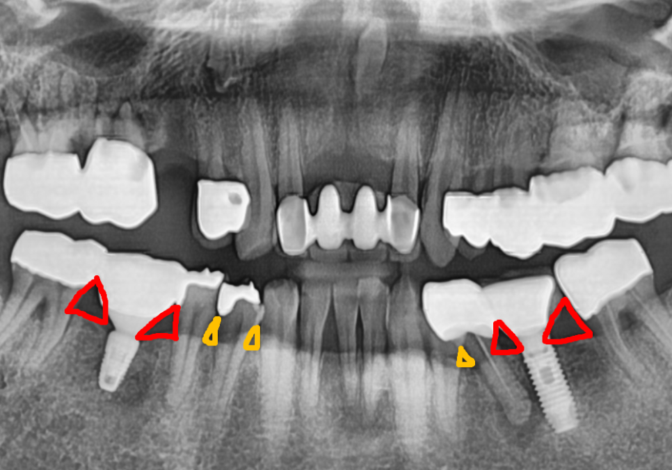 상일역 임플란트, 음식물 끼는 이유, 처음엔 안 그랬는데 왜 점점 심해지는 걸까요? 관련 이미지 5