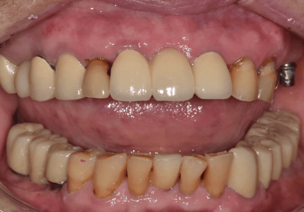 상일동 임플란트 심한 충치로 인한 치아 부러짐 해결한 사례 관련 이미지 13