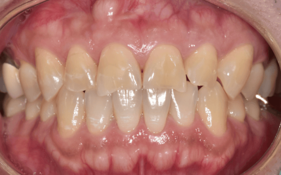 앞니 깨졌을 때, 치아 파절 실비 가능한가요? 관련 이미지 7