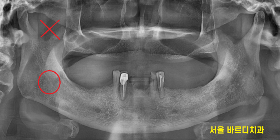 상일동 치과 임플란트 국가 지원 혜택 싹 정리했습니다. 관련 이미지 4