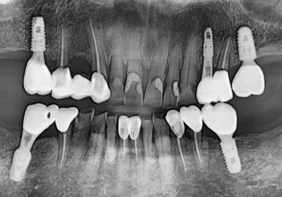 앞니 음식물 끼임, 왜 젊을 때보다 더 자주 발생하는 걸까요? 까맣게 변한 앞니 치료 사례 관련 이미지 7
