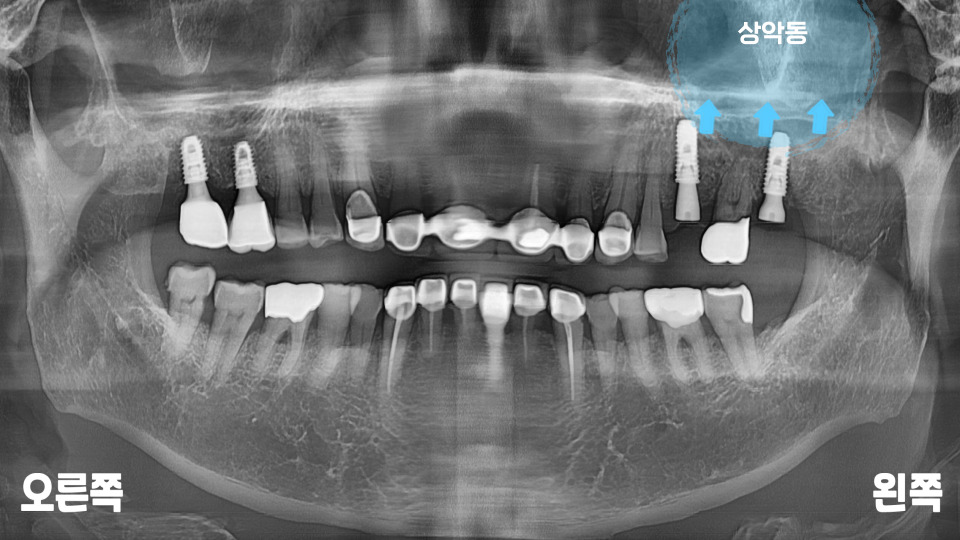 서울바르디치과 뿌리 끝 염증 심한 치아를 네비게이션 임플란트 #6 관련 이미지 10