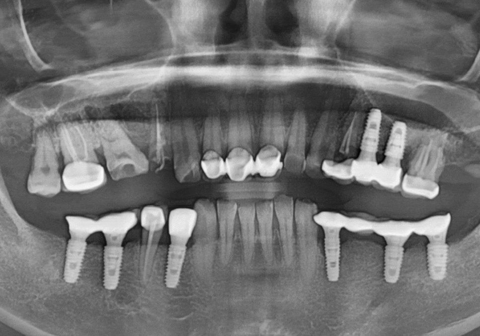 강동구 오래된 보철, 교체 시기는? 아프지 않은데 꼭 바꿔야 하나요? 관련 이미지 17