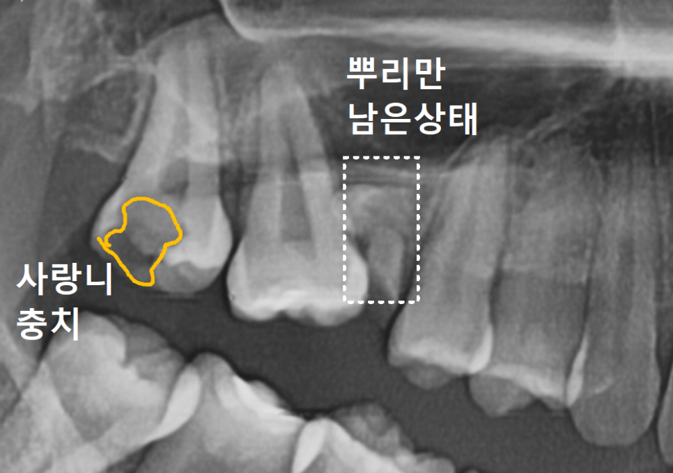 Myeongil-dong Implant Treatment in Your 20s: The Reason It Ended Up Requiring Bone Grafting After Thinking, “I’m Young, So It’ll Be Fine” image 4