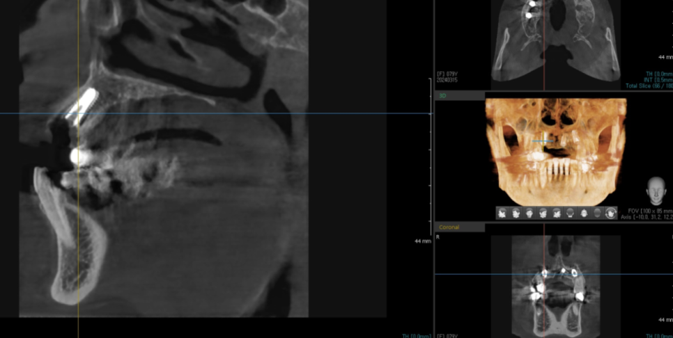 하남미사치과 앞니 브릿지를 임플란트로 교체했습니다. 관련 이미지 5