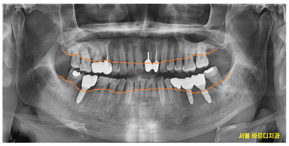 감일동 치과 어금니 시림 충치가 아닐 수도 있다? 임플란트 하게된 사연 관련 이미지 4