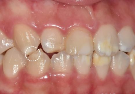 고덕역 치과 반점치 얼룩덜룩한 치아, 치료 실패 줄이는 5가지 기준 관련 이미지 7