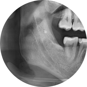 상일동 치과 매복 사랑니 발치 비용 정리해보았습니다!! 관련 이미지 4