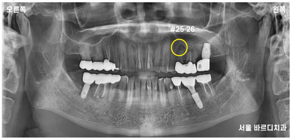 하남 미사 치과 발치 후 당일 임플란트가 가능합니다. 관련 이미지 1