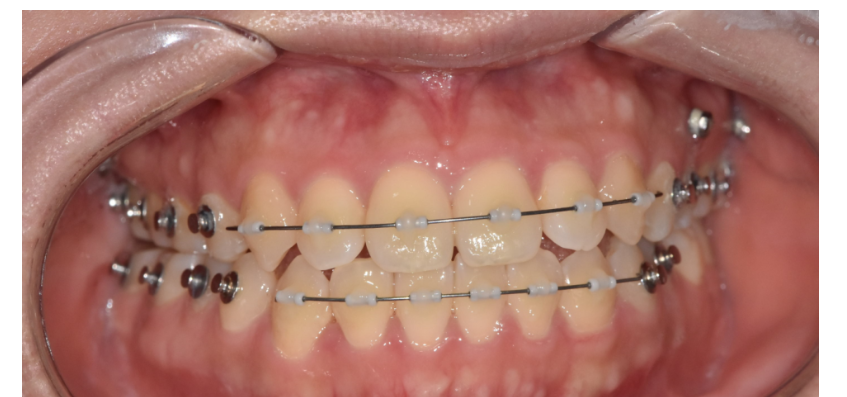 서울 투명교정 이거 모르면 후회합니다. 관련 이미지 6
