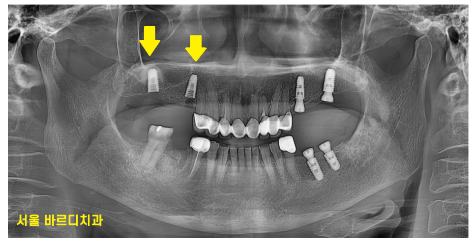 하남 임플란트 치과 주문진에서부터 치료 받으러 오신 환자분 관련 이미지 9