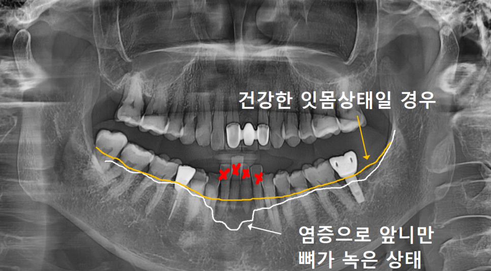 보험 임플란트 비용, 왜 치과마다 이렇게 다를까? 관련 이미지 7