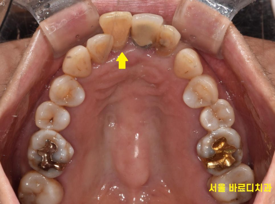 상일동역 치과 윗니 앞니 흔들림 임플란트로 심미까지 잡았습니다. 관련 이미지 5