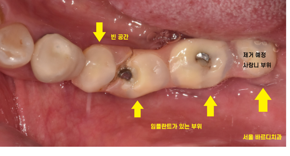 고덕동치과 이가 다 부서졌을 때 임플란트 치료했습니다. 관련 이미지 6