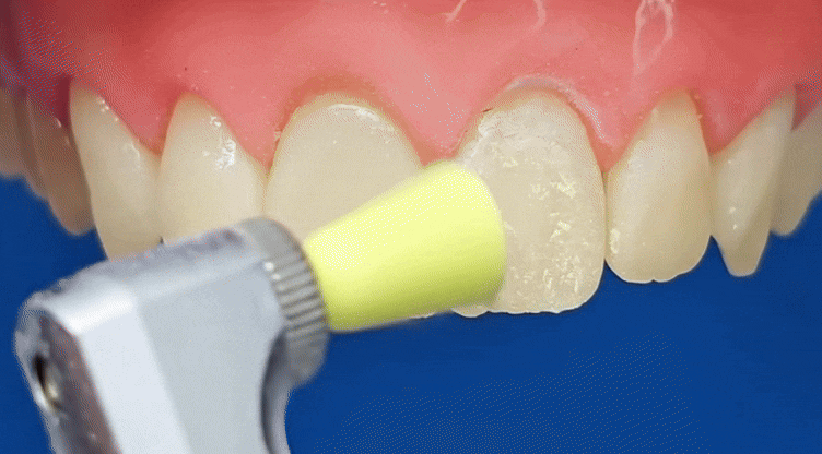 강일역 치과, 검게 보이는 앞니 레진 변색, 무조건 새로 해야 할까요? 관련 이미지 7