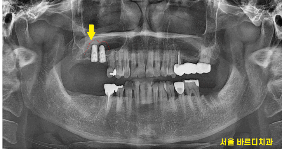 미사 임플란트 상악동 거상술 제일 어렵고 난이도가 높습니다. 관련 이미지 1