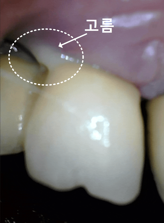 잇몸 고름 눌러보니 푹... 임플란트 주위염 방치했다가 재수술한 사례 관련 이미지 3