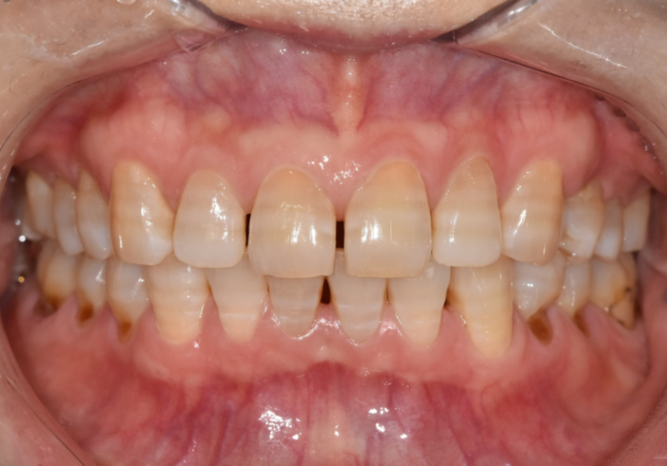 50대 라미네이트, 앞니 벌어짐과 변색 고민 이렇게 해결했습니다. 관련 이미지 1
