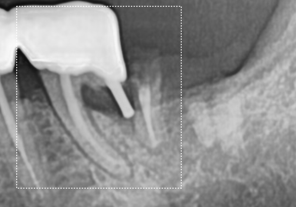 강동구 임플란트 기간, 사람마다 왜 다를까? 즉시식립과 지연식립의 결정적 차이 관련 이미지 11