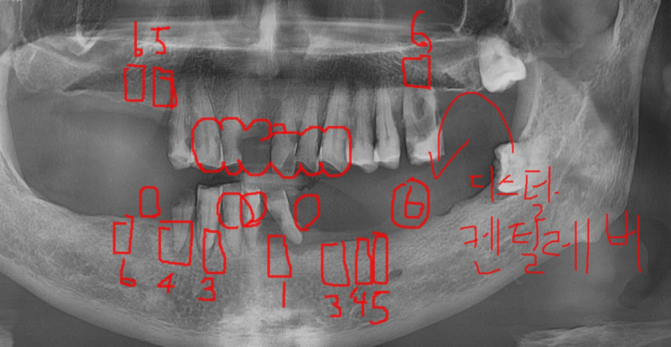 외국인 치과 진료 하악 전체 임플란트 7개 심어 12개 치아 만들기 관련 이미지 7