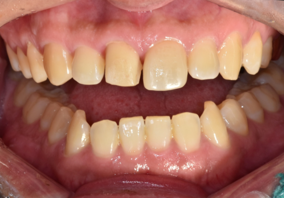 천호 라미네이트 파절 탈락, 줄이려면 치과 선택이 중요합니다. 관련 이미지 12