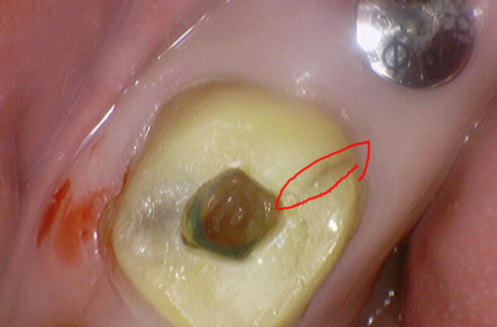 씹을때 찌릿 치아균열증후군 보이지 않아 위험합니다. 관련 이미지 1
