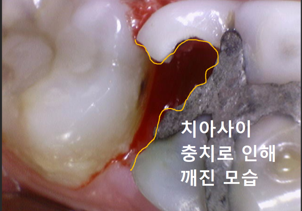 고덕동 어금니 사이 충치, 양치질 누구보다 열심히 하는데 왜 자꾸 생길까요? 관련 이미지 9
