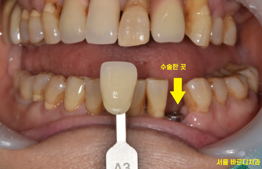 명일동 치과 심미적인 앞니는 하루만에 끝내는 빠른 임플란트로 하세요!! 관련 이미지 9