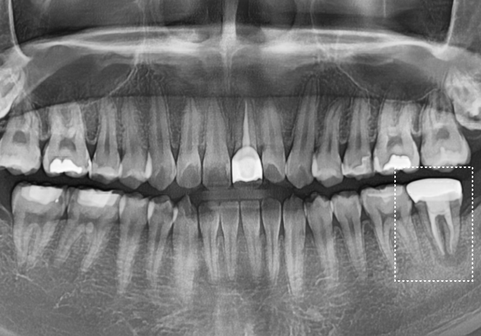 어금니 염증, 자연치 살리기에 진심인 저는 이렇게 살렸습니다. 관련 이미지 5