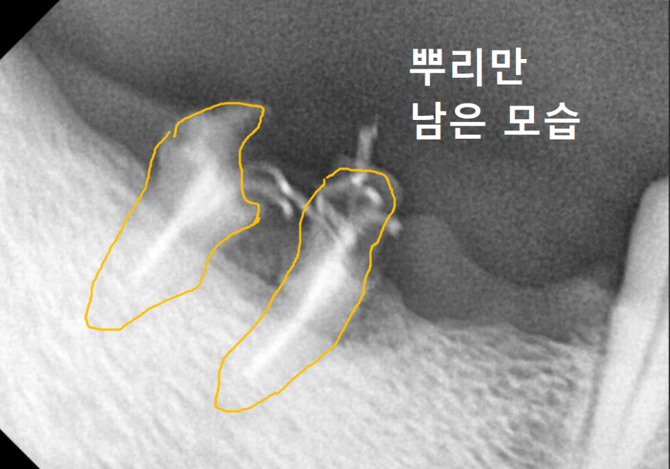 고덕동 어금니 브릿지 교체, 관련 이미지 9