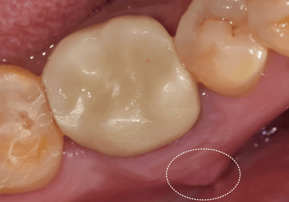 강동구 잇몸 여드름, 이런 상태라면 절대 겉에만 짜는 치료 하지 마세요. 관련 이미지 11