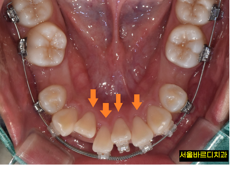 치아 교정 스프링 공간을 확보하기 위한 오픈코일 알아봐요 관련 이미지 3