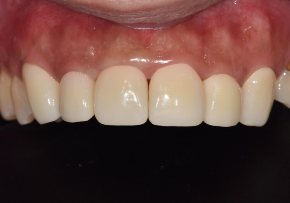 A Single Black Spot of Decay Between the Front Teeth May Be a Warning Sign of Multiple Cavities. image 13