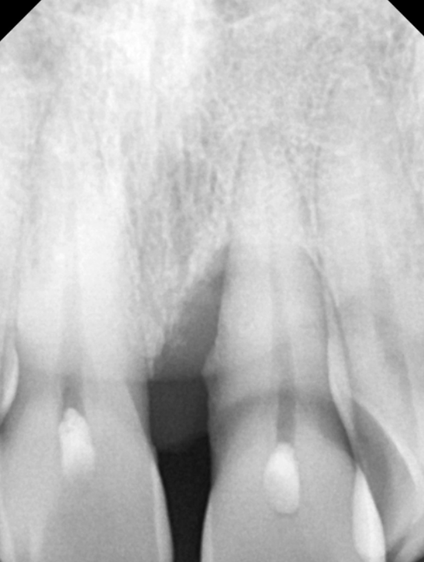 잇몸 내려감으로 길어진 치아, 방치하면 안 되는 원인, 증상, 이유 관련 이미지 7