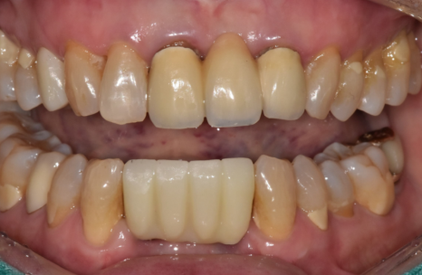 솟구치는 앞니, 흔들리는 치아가 보내는 관련 이미지 16