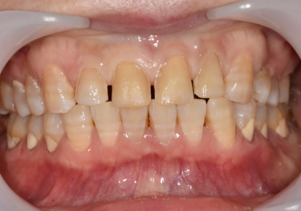 앞니 변색, 치아미백효과 없는 이유 솔직하게 말씀드립니다. 관련 이미지 6