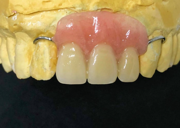 잇몸 까매짐 원인,증상,치료 방법 오래전에 앞니 씌운 곳 잇몸이 까매졌어요. 관련 이미지 13