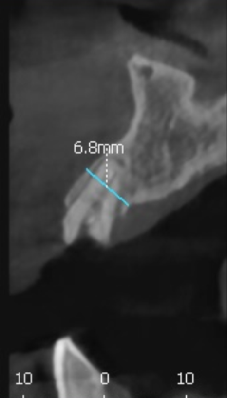 앞니 브릿지 부러짐, 이런 상태라면 절대 브릿지 다시 하지 마세요. 관련 이미지 9