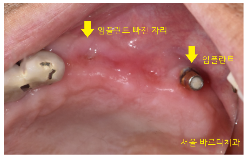 덕풍동 치과 오래된 임플란트 제거 후 재식립하였습니다. 관련 이미지 8
